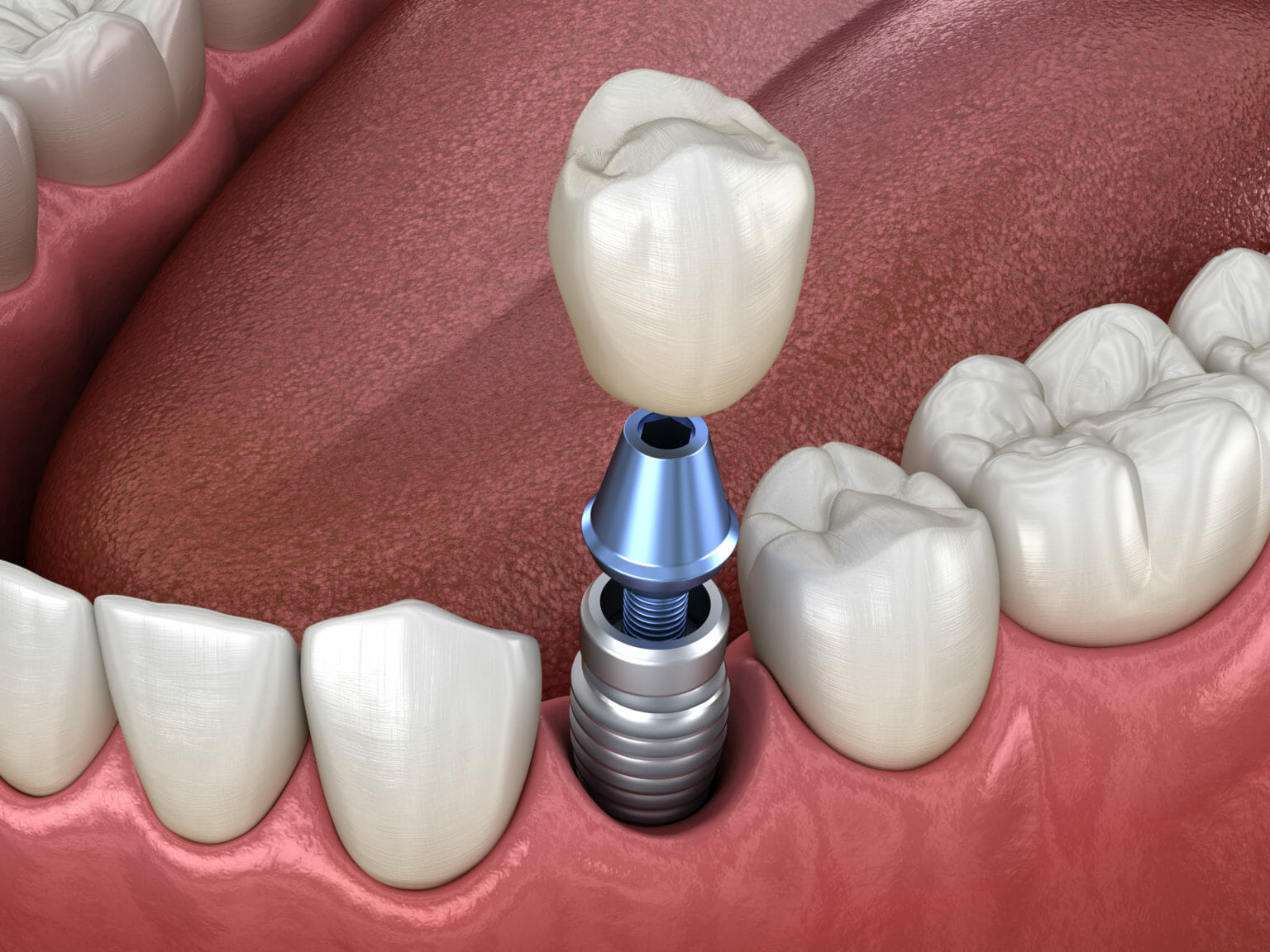 Dental Implants Rosenberg - Dental Restoration Rosenberg