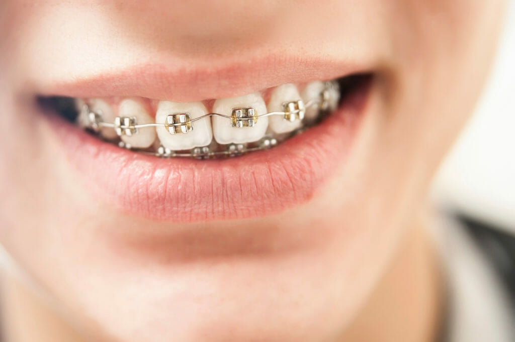 Traditional Brackets Braces Orthodontist Rosenberg Orthodontics